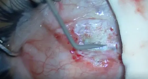Ahmed Glaucoma Valve Tube Expansion