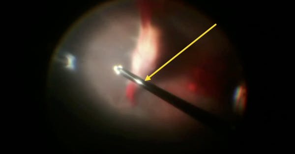 Vitrectomy in Eyes With ROP thumbnail