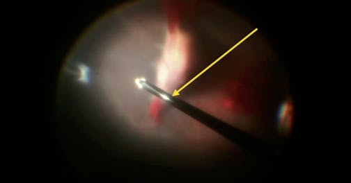 Vitrectomy in Eyes With ROP and PFV
