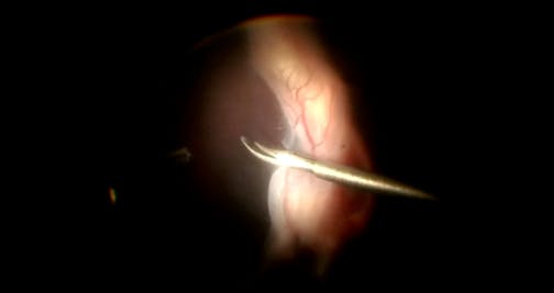 Retinal Fold Membrane Trimming