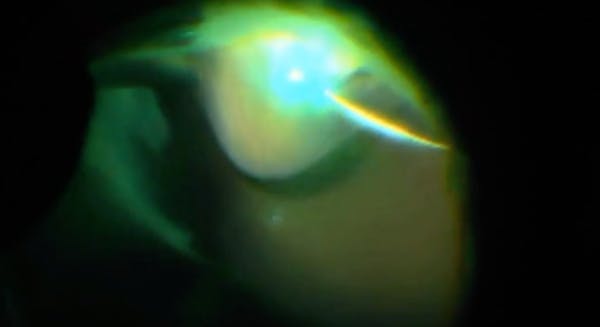 Laser Barrage With Cohesive Viscoelastic thumbnail