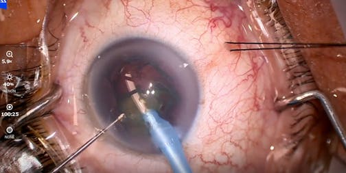 miCOR Lens Extraction - Eyetube
