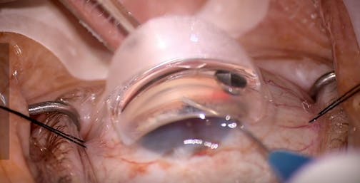 Canaloplasty: Addressing the Entire Outflow System