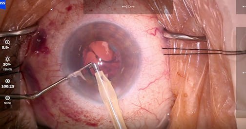 Cataract Extraction in a Hyperopic Eye With a Small Pupil