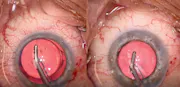 Delayed Blanching of Episcleral Venous System