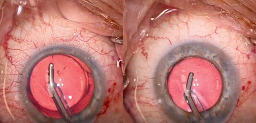 Delayed Blanching of Episcleral Venous System