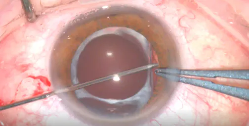 Explantation of Opacified Multifocal IOL With Severe Zonular Weakness