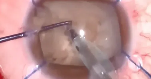 Mechanical Chopping in Various Types of Cataracts