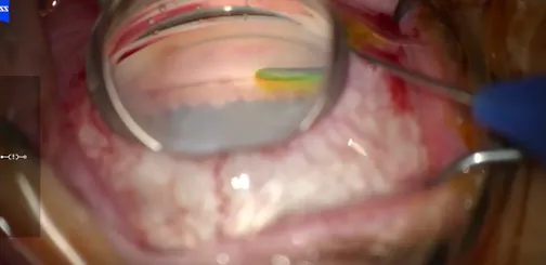 Canaloplasty Combined With Phacoemulsification and Channellography