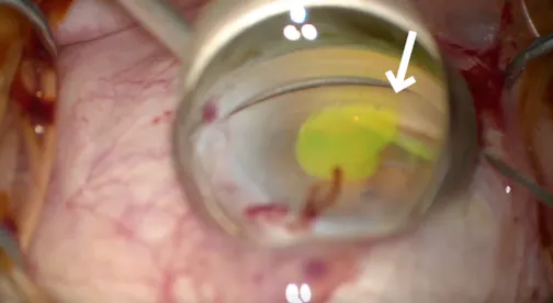 Canaloplasty Via Ab-Interno Approach: Highlighted With Fluorescein Channelography