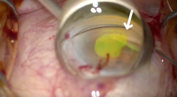 Canaloplasty Via Ab-Interno Approach: Highlighted With Fluorescein Channellography thumbnail