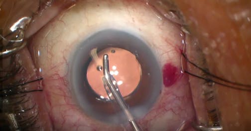 Significant Episcleral Venous Blanching