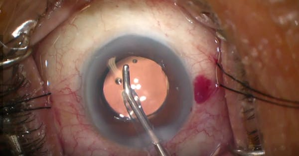 Significant Episcpleral Venous Blanching thumbnail