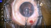 Intrastromal IOL injection