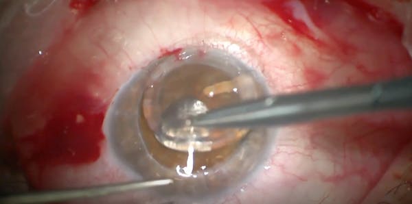 Nightmare During Suture Removal thumbnail