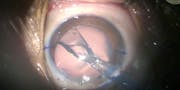 Mega Implantable Contact Lens