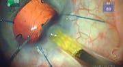 Capsular Bag Transplantation