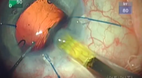 Capsular Bag Transplantation thumbnail