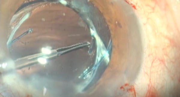 IOL Optic Transplant thumbnail