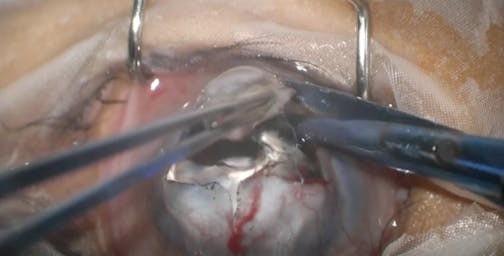 Staphyloma