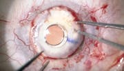 Two Keratoprostheses