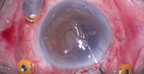 Dislocated Lens, Lens Fragment Removal, and Secondary IOL