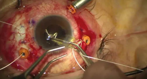 Four-Point PhysIOL Fixation With Gore-Tex Suture