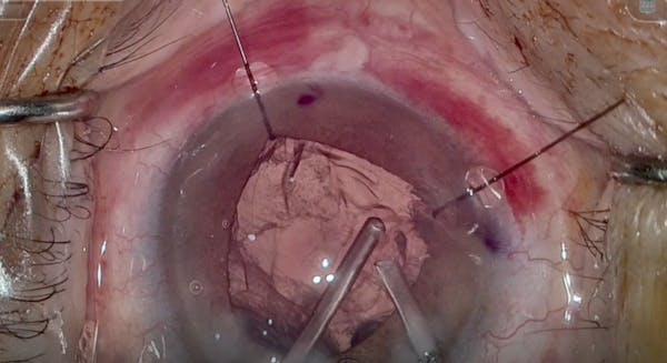 Cataract Pieces: Vitrectomy Pearls thumbnail