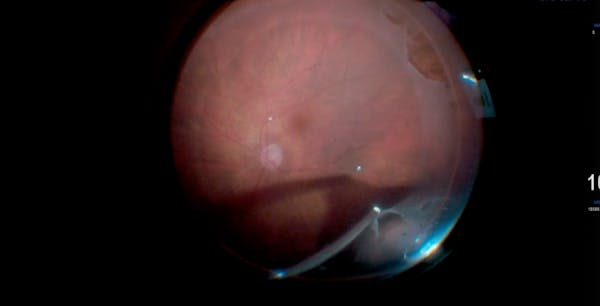 PPV for Retinal Detachment With Zipper Syndrome thumbnail