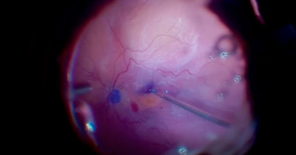 Rhegmatogenous Retinal Detachment With Posterior PVR thumbnail