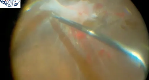 Bimanual Repair of Chronic Diabetic Tractional Retina Detachment