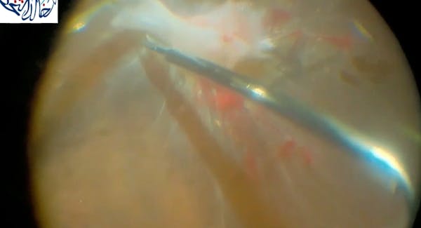 Bimanual Repair of Chronic Diabetic Tractional Retina Detachment thumbnail