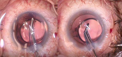 Streamline Viscodelivery and Goniotomy