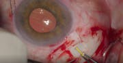 Iluvien Implant Suture