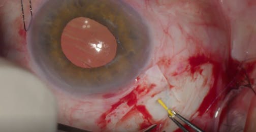 Iluvien Implant Suture