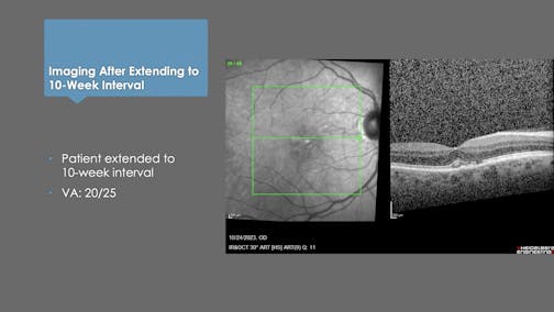 Switch Case: 66-Year-Old Man With Wet AMD
