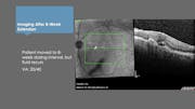 Potential Switch Case: 81-Year-Old Man With Wet AMD