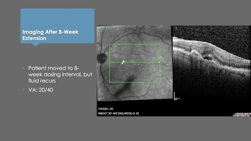 Potential Switch Case: 81-Year-Old Man With Wet AMD