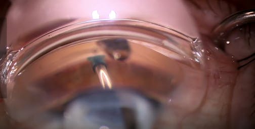 Demonstration of Streamline Surgical System