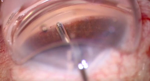 iDose Implantation thumbnail
