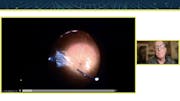 The Role of Imaging in Assessing Vitreous Opacities