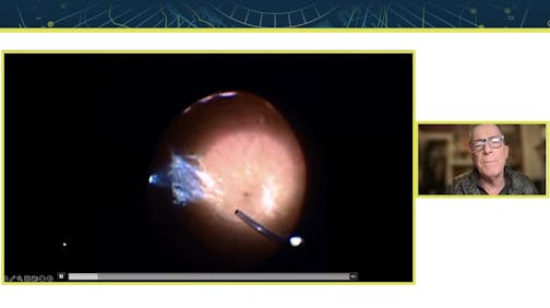 The Role of Imaging in Assessing Vitreous Opacities