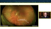 Pearls for Surgical Management of Vitreous Opacities
