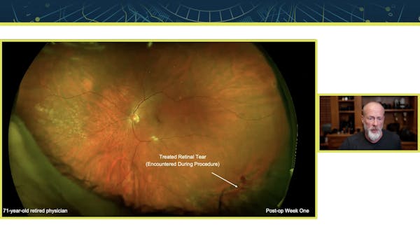 Pearls for Surgical Management of Vitreous Opacities thumbnail