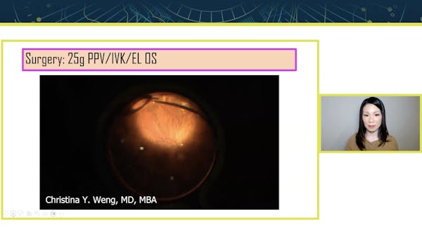 Surgery for Vitreous Opacities in an Eye With MFIOL, Previous History of Retinal Tears thumbnail