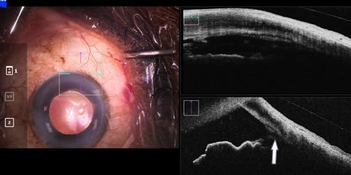 KDB Excisional Goniotomy With Intraoperative OCT