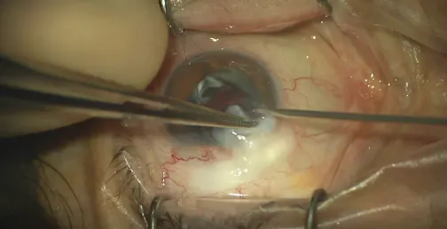 Overhanging Bleb Excision