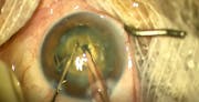 Vertical Chop in Brunescent Cataract