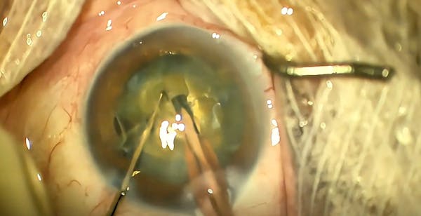 Vertical Chop in Brunescent Cataract thumbnail