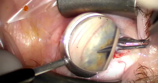 Goniotomy BANG Technique